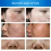 آلة تنظيف الوجه هيدرا الماس قشر microdermabrass