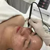 Przenośna technologia Korea sprzęt RF akacja urządzenie do leczenia trądziku profesjonalna maszyna do usuwania blizn punktowych pielęgnacja skóry odmładzanie Salon kosmetyczny