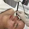 Bärbar Korea Teknik RF-utrustning Acacia Acne Behandlingsanordning Professionell fläckarr Borttagning Maskin Hudvård Föryngring Skönhetssalong