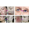 Professionell ozonplasmapenna 2 i 1 för hudsträngning av plasma ärrborttagare fräknad borttagning Ögonlock Lyftning Plasma Beauty Machine