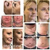 Outros equipamentos de beleza 9D HiFu Face Levating e Máquina de ultrassom de emagrecimento do corpo para terapia 3D HIFU Portátil Skin