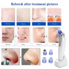 System diagnostyczny próżnia blackhead semover nos facial por cleaner ssania dot Acne czarny głowy pryszcz kosmetyczne narzędzie do pielęgnacji skóry