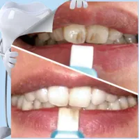 Kit de limpieza de dientes Bisqueros Kits de blanqueamiento dental tiras de limpieza para profundo oral