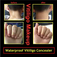 Waterdichte vitiligo gezicht concealer pen voor dekking handen lichaam lukasmus witte vlekken verbergen huid leukoderma instant make-up vloeibare pen 2pcs / lot