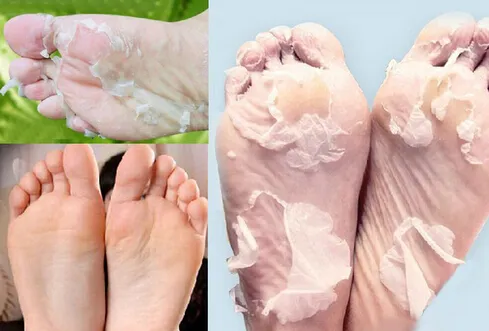 Best Way to Remove Dead Skin From Your Feet